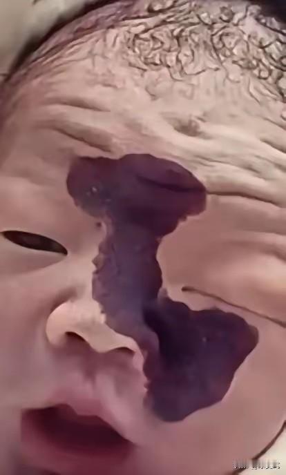 泪目！一对年轻夫妻，怀孕时在检查室看到宝宝脸上有一道黑影，医生说可能是胎记，丈夫