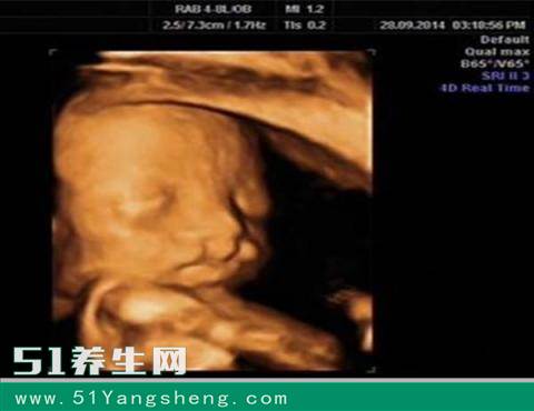 六个月的胎儿查出兔唇, 原因让妈妈无法原谅自己