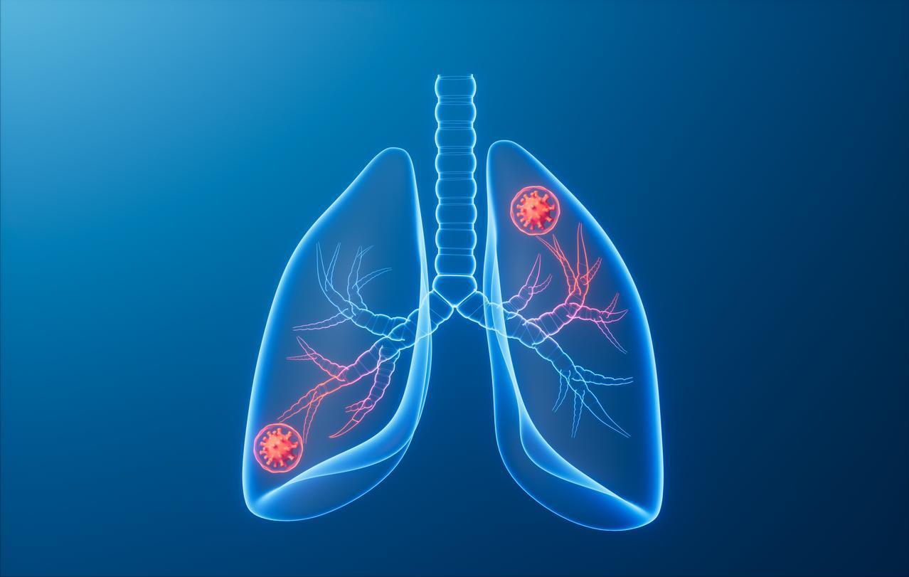 肺癌致死原因普通人理解不了，它和其他肺病不一样，秘密存在基因里最近门诊上一个病