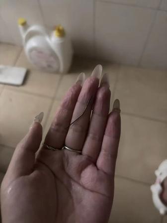 头皮发麻！浙江一姐们儿屁股疼了整整一个月，还以为是自己锻炼拉伤了肌肉，压根没当回
