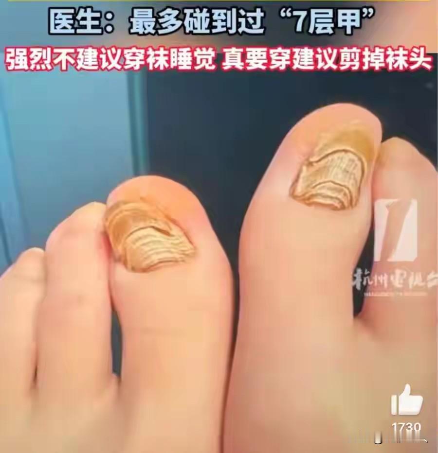 警惕！26岁姑娘睡前这个习惯，把脚趾甲睡成“千层糕”，只能拔甲！天冷脚凉，穿双