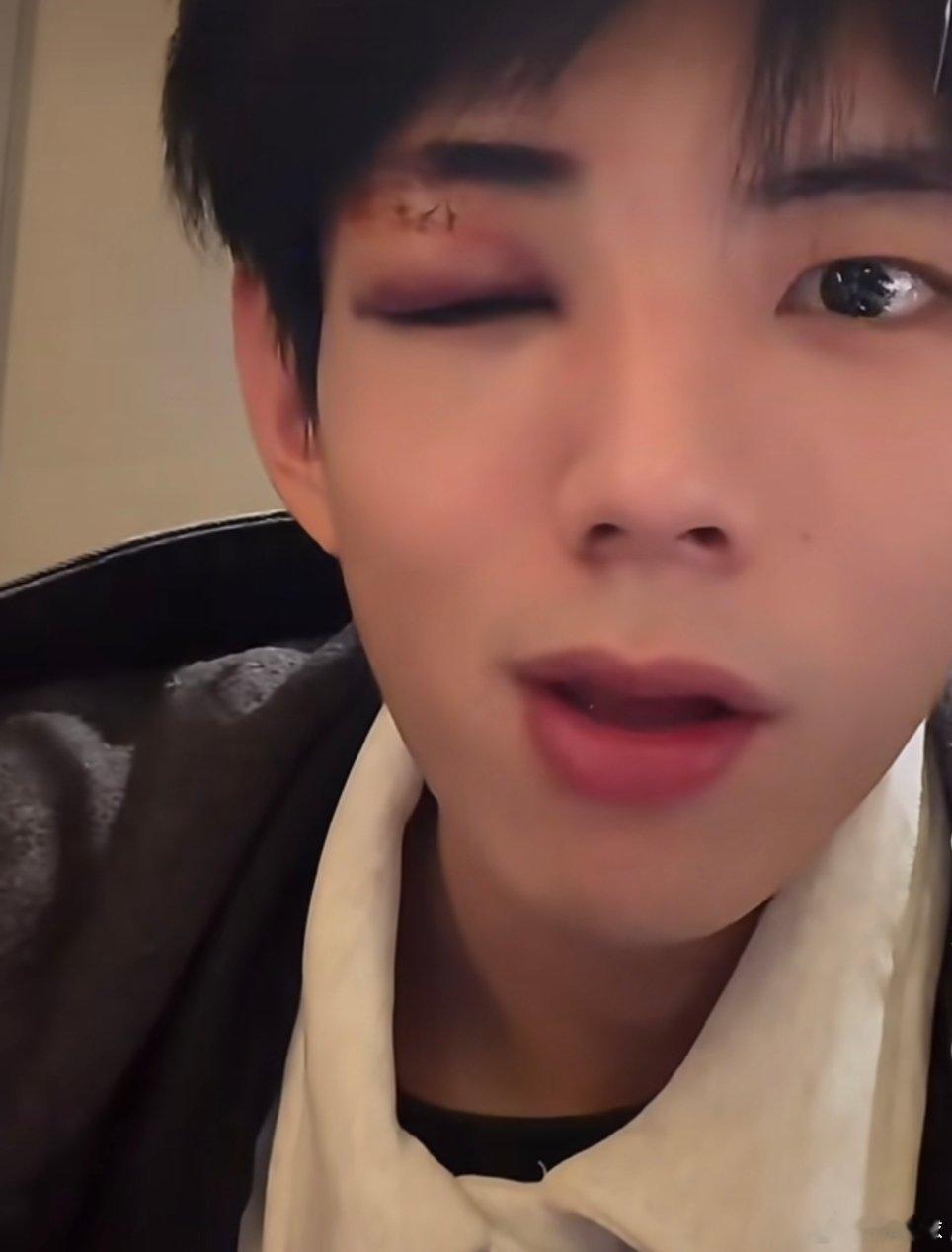 短剧被真打演员王年将成，眼部浮肿，还缝针了，男二还有人敢用吗？下手这么狠，演员不