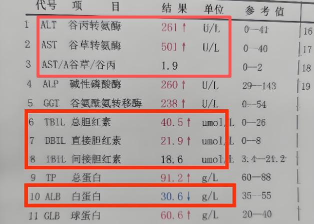 转氨酶升高不可怕，这两个指标异常才是真危险！一提到肝病，很多人马上就想到