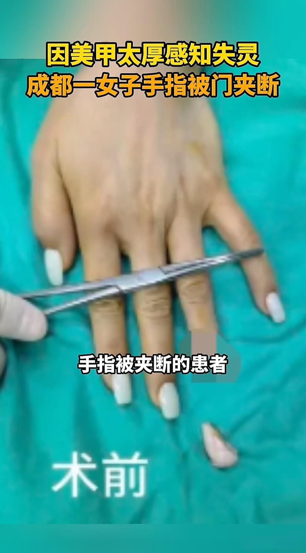 太吓人了！四川女孩手指被门夹断，谁都想不到，竟然是因为她左手无名指上的美甲做