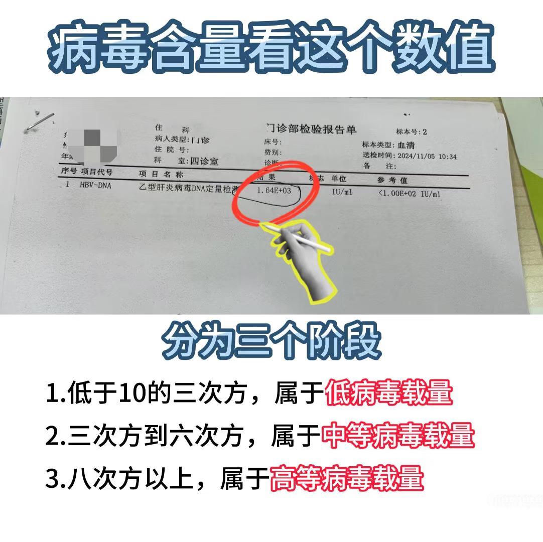 乙肝病毒量的高低是评估乙肝病毒感染状态的重要指标：  高病毒载量:病毒...