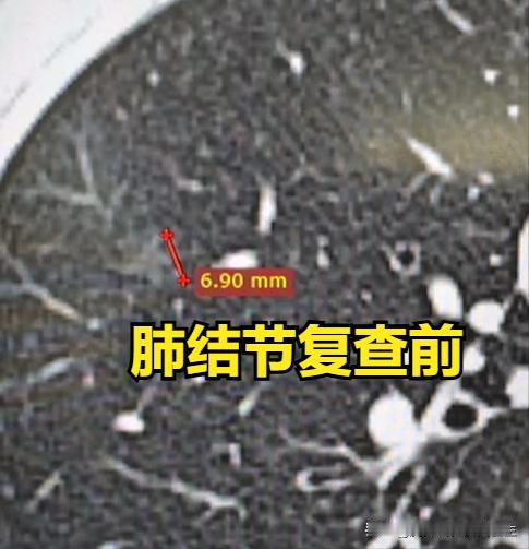肺里查出结节、肿块或占位，到底哪个才是癌？很多朋友做完胸部CT或X光，看到报告上