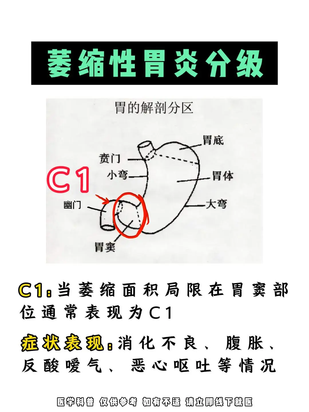 关于萎缩性胃炎的分级你知道吗？
