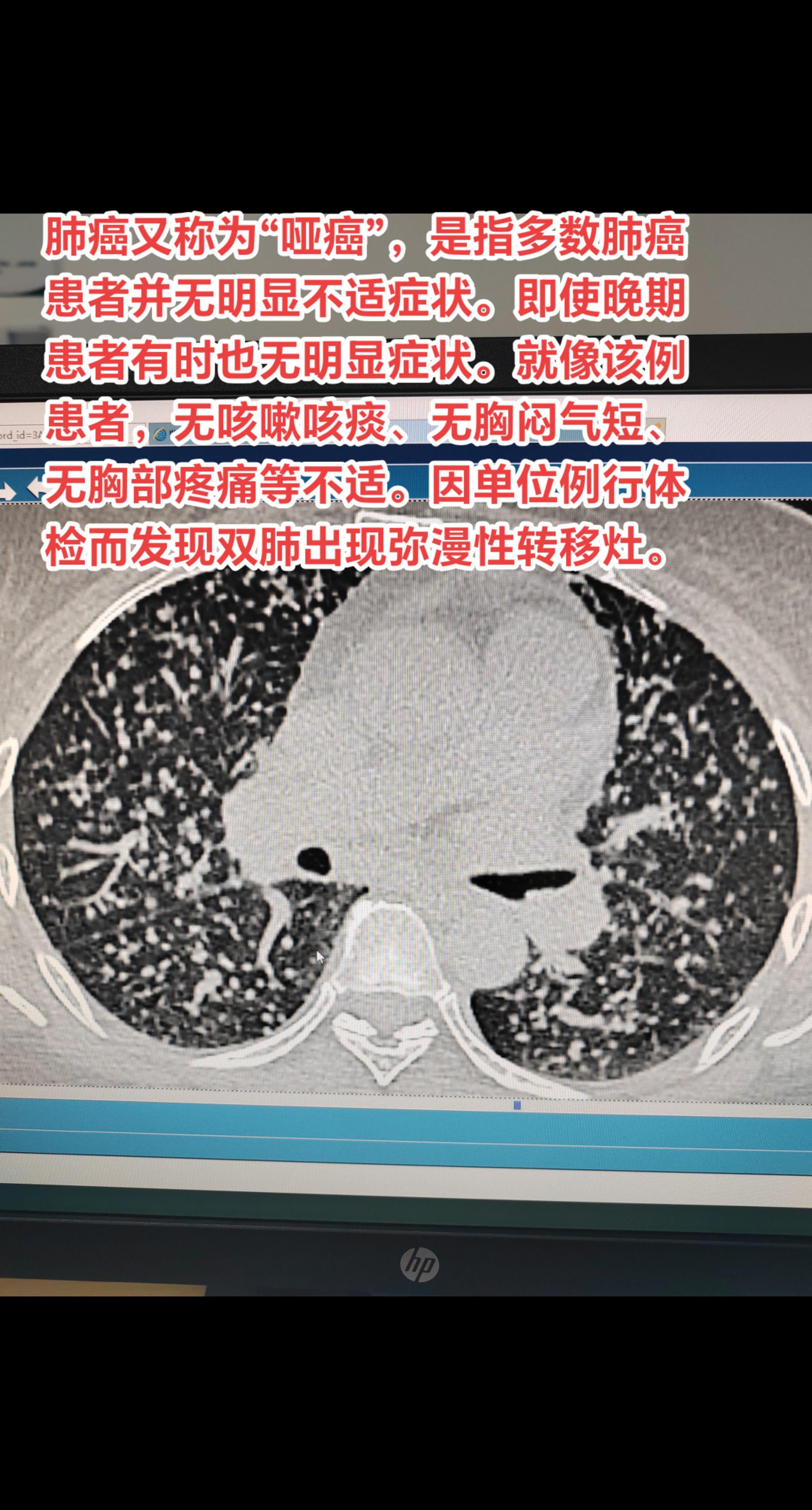 肺癌肺部转移结节。肺癌又称为“哑癌”，是指多数肺癌患者并无明显不适症状...