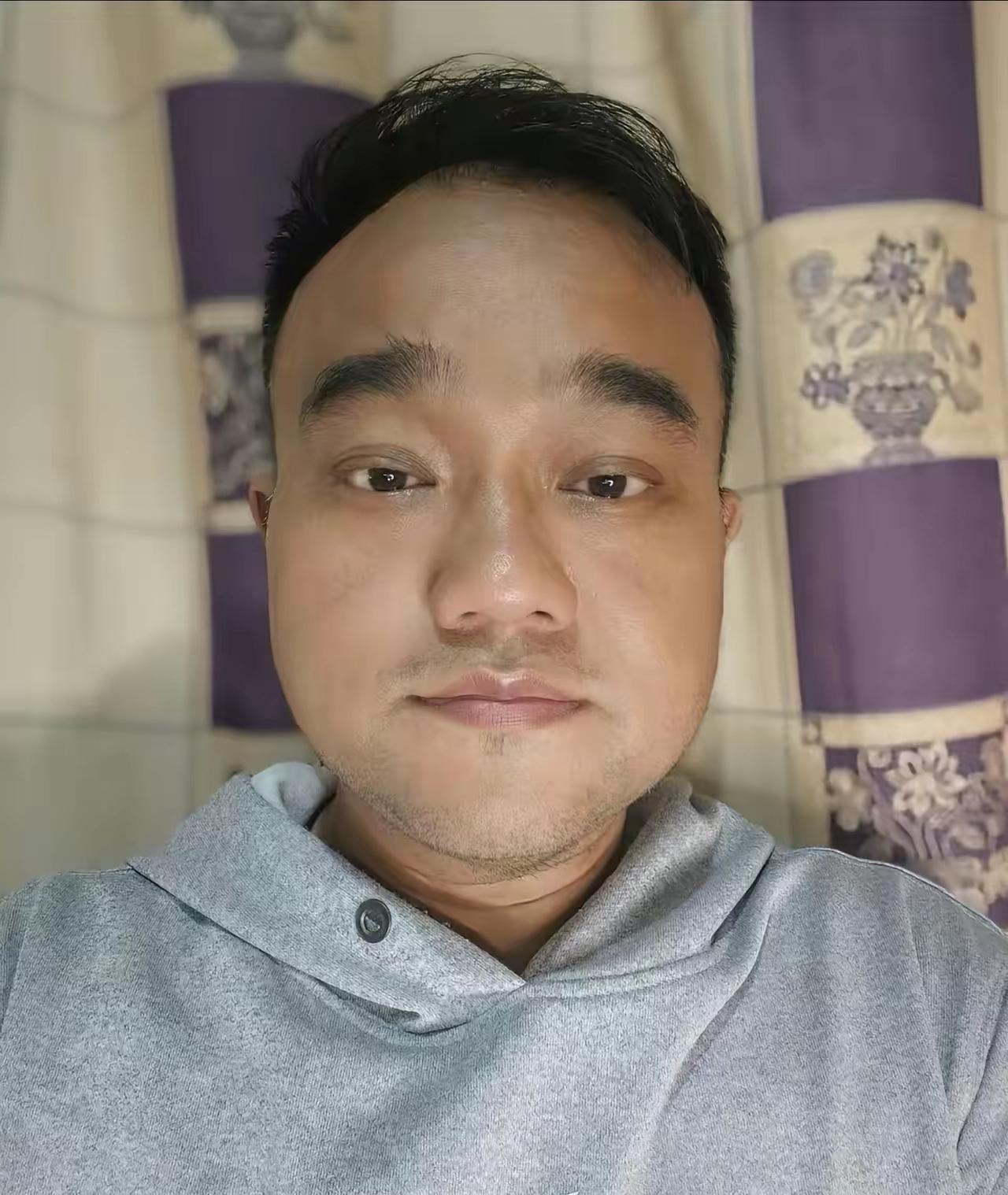 谭秦东现在每天要靠透析维持生命。他从慢性肾病四期恶化到终末期肾衰竭。每周必须