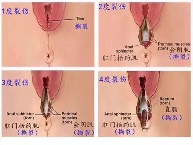 顺产也挨刀? 产后护理做好这6点, 会阴侧切不再是噩梦
