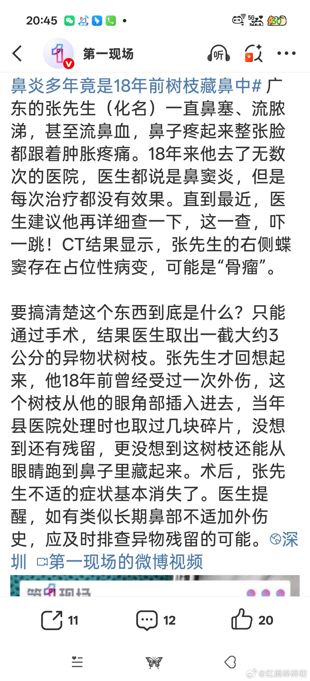 男子鼻炎多年竟是18年前树枝藏鼻中好可怕的感觉！！！还好没伤到要害！！还好后来去