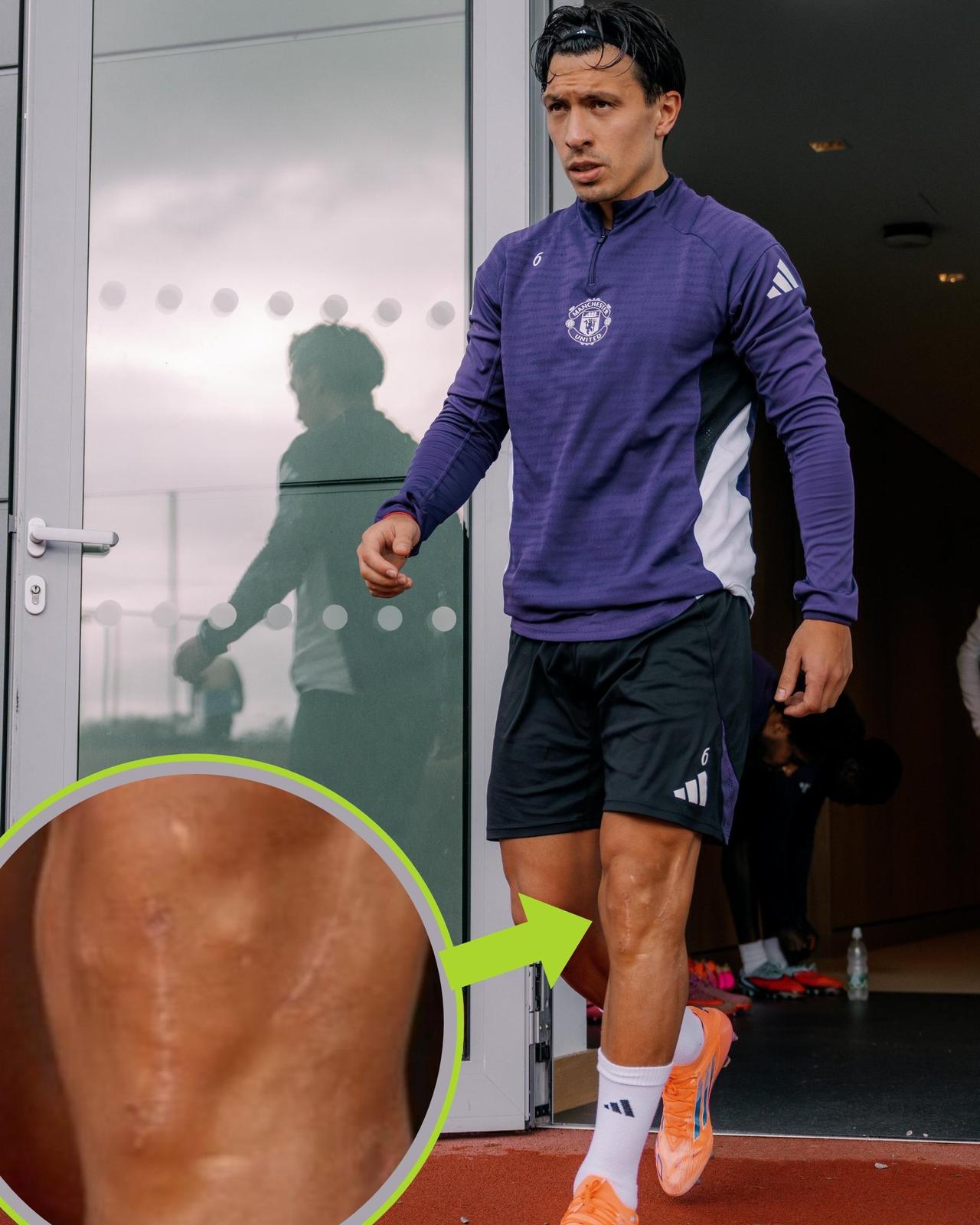 利马今天的图片,左脚膝盖处,可以轻易看到手术痕迹。加油👏