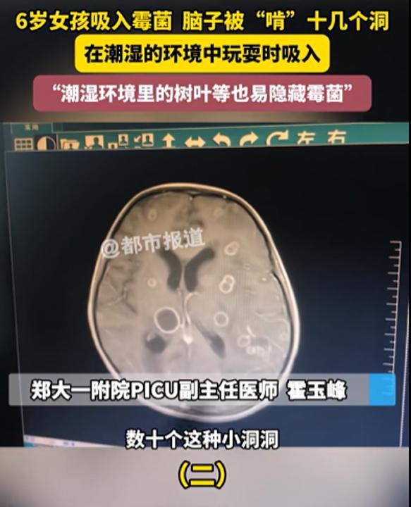 6岁女孩发烧17天意识不清, 医生检查后大吃一惊: 脑子被“啃”出十几个洞!