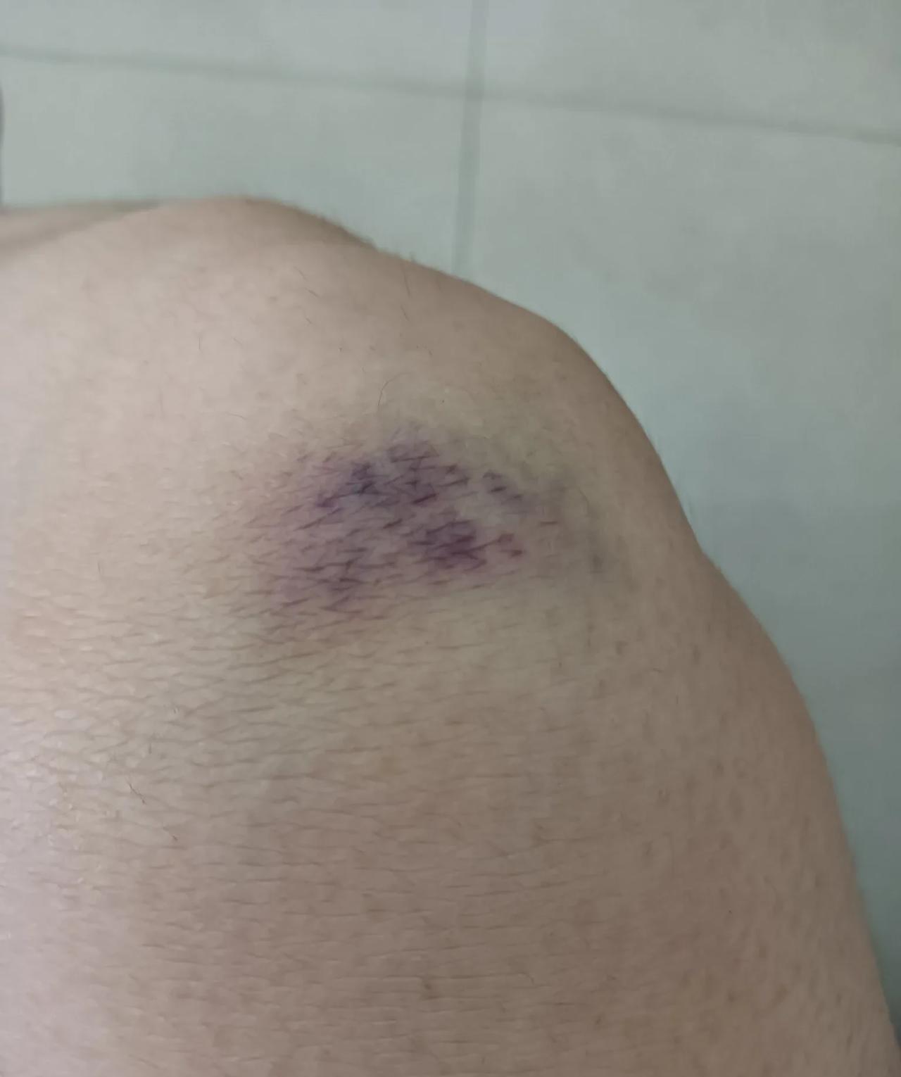昨天晚上父子俩又干仗了！我因为护子心切也受了伤！昨天晚上孩子爸回来，儿子砸在地