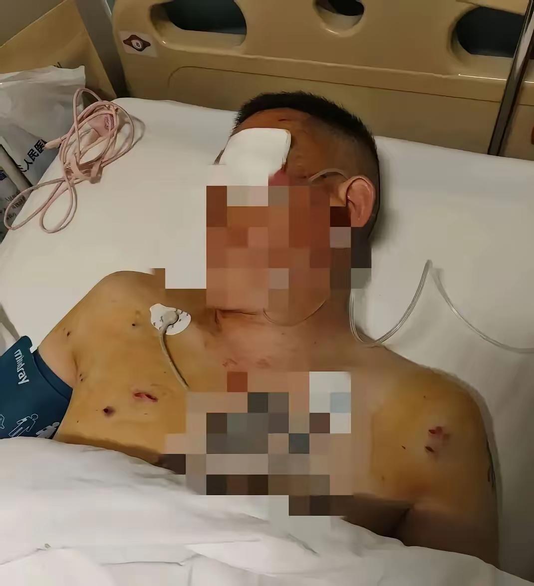 河南郑州一银行门口出事了，倪先生取钱后被抢劫，伤得很重，左眼都看不见了。犯罪的是