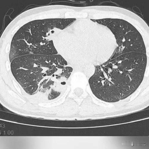 20岁男生挤颗痘险丢命，肺被啃出10多个空洞，危险三角区真碰不得谁能想到挤