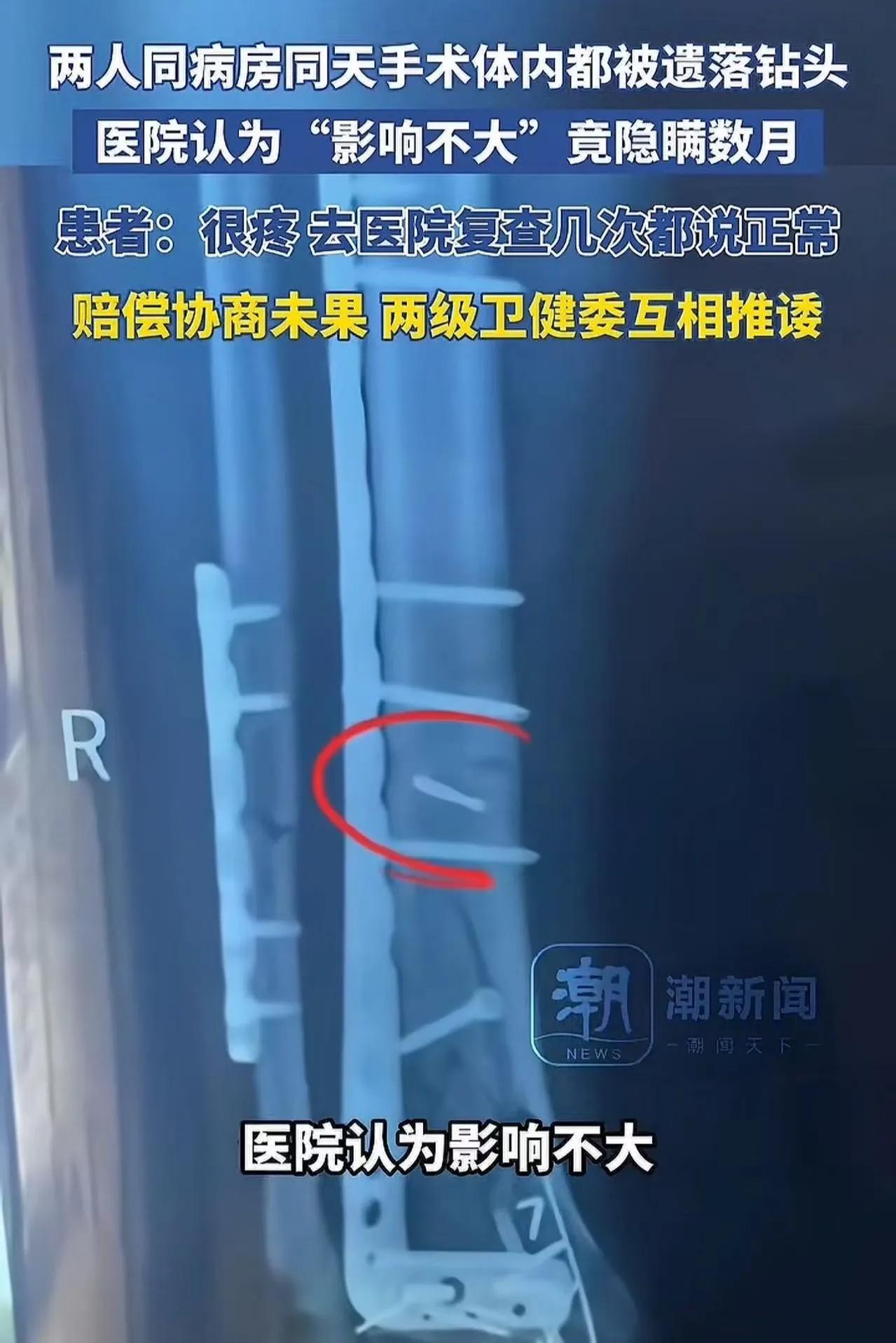 离了个大谱！湖南icon，两人同病房同一天手术，体内都被遗落钻头，医院认为影响不