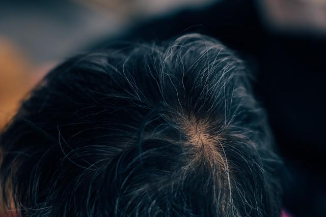 男性脱发根源揭秘：不是压力大，而是这4种生理机制在作怪！提示：本内容仅供健