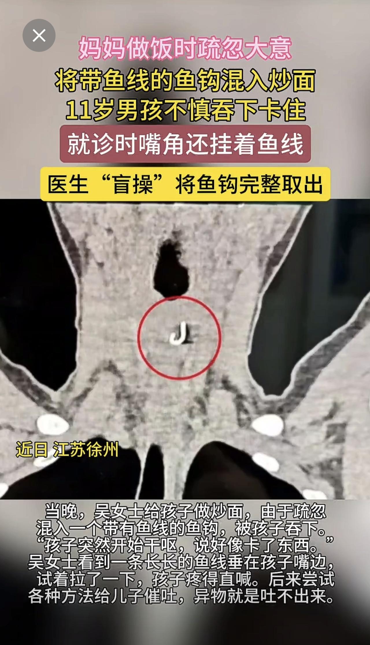 妈妈疏忽将带鱼线的鱼钩混入炒面11岁男孩不慎吞下卡住（现代快报）