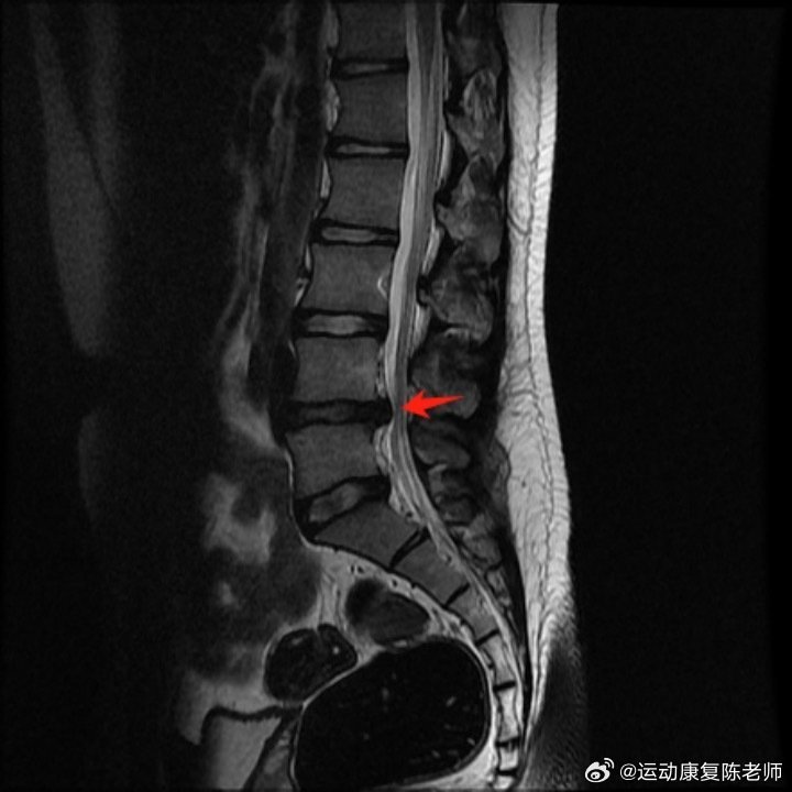 腰椎间盘突出腰椎间盘膨出、突出、脱出，它们对应的症状与区别，今天借助核磁影像学
