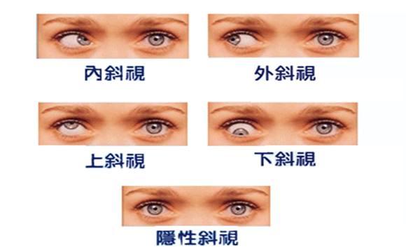 眼科医生称, 斜眼宝宝在逐年增多, 家长们的某些行为, 应立即停止!