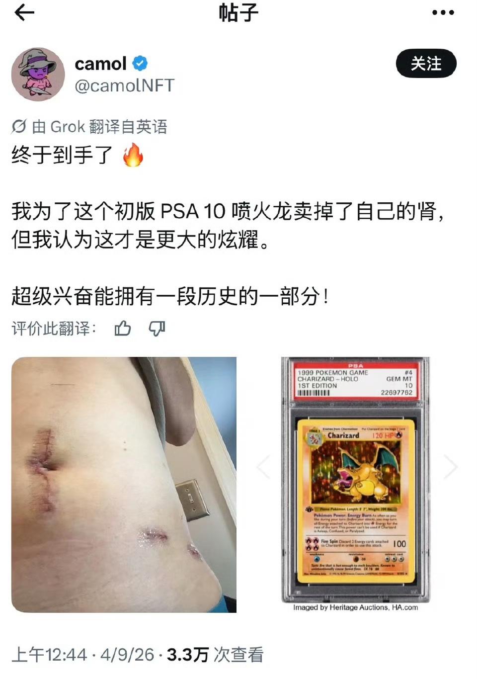 为了一张宝可梦卡片卖掉了自己的肾？岁数大了，不知这是啥玩意，咋就这么痴迷呢？早些