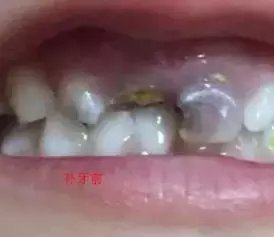 给娃看牙花了一个LV! 专业牙医告诉你该如何保护乳牙