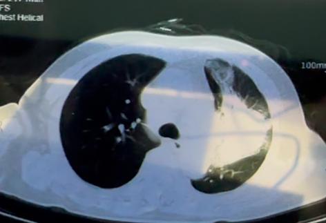 小细胞肺癌，有淋巴转移、肝转移、骨转移、肾上腺可能也有转移，像这种情况还有手术机