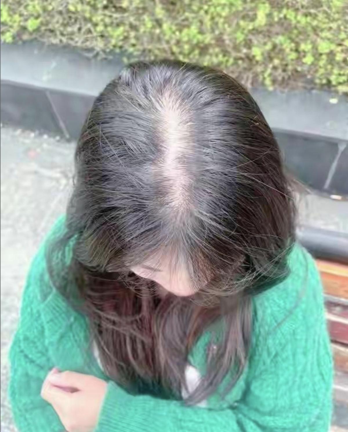 面对脂溢脱发，一位过来人的几点养护心得曾经，我每天早晨的第一件事不是睁开双眼