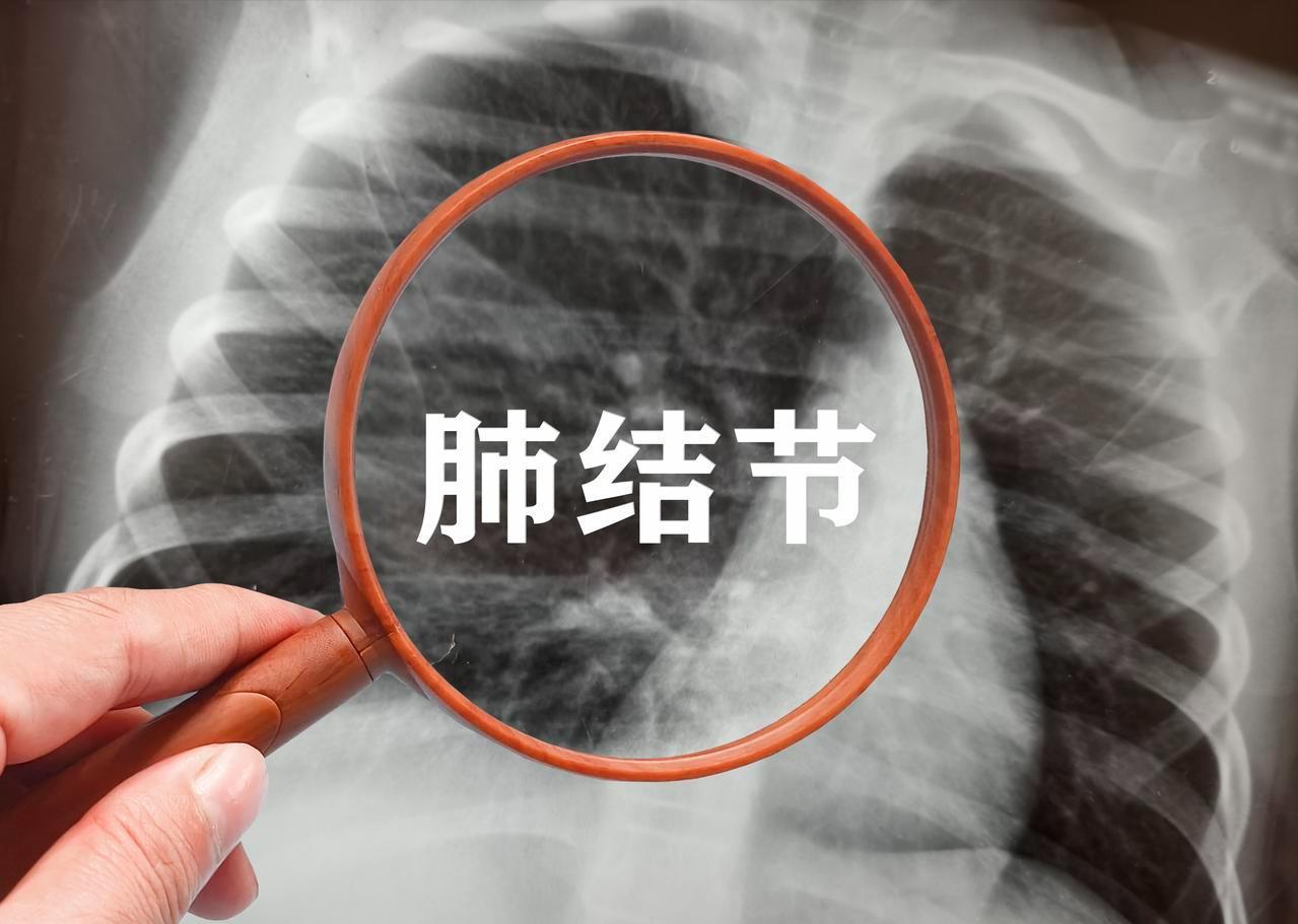 磨玻璃结节最可怕？其实如果同样是癌，实性结节恶性程度更高肺部结节大家都很害怕，