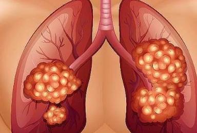 新辅助治疗后肿瘤消失了，手术白做了？答案恰恰相反 有些胃癌患者做完新辅助治疗