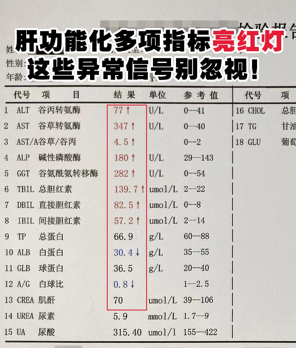 看这位患者的肝功能化验单，情况很不乐观。谷丙77U/L、谷草347U...