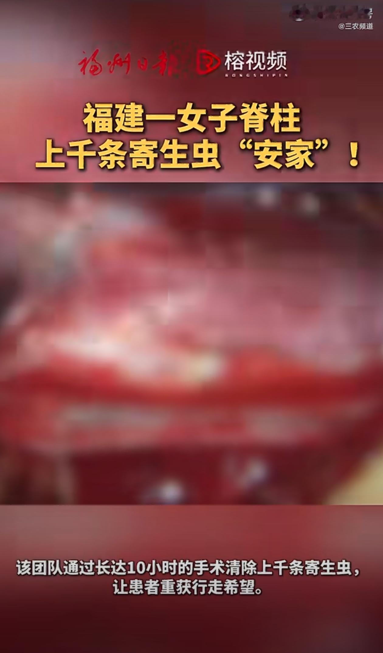 5月16日报道，福建福州发生了一起罕见的医疗事件，一位57岁的农村妇女李女士，在