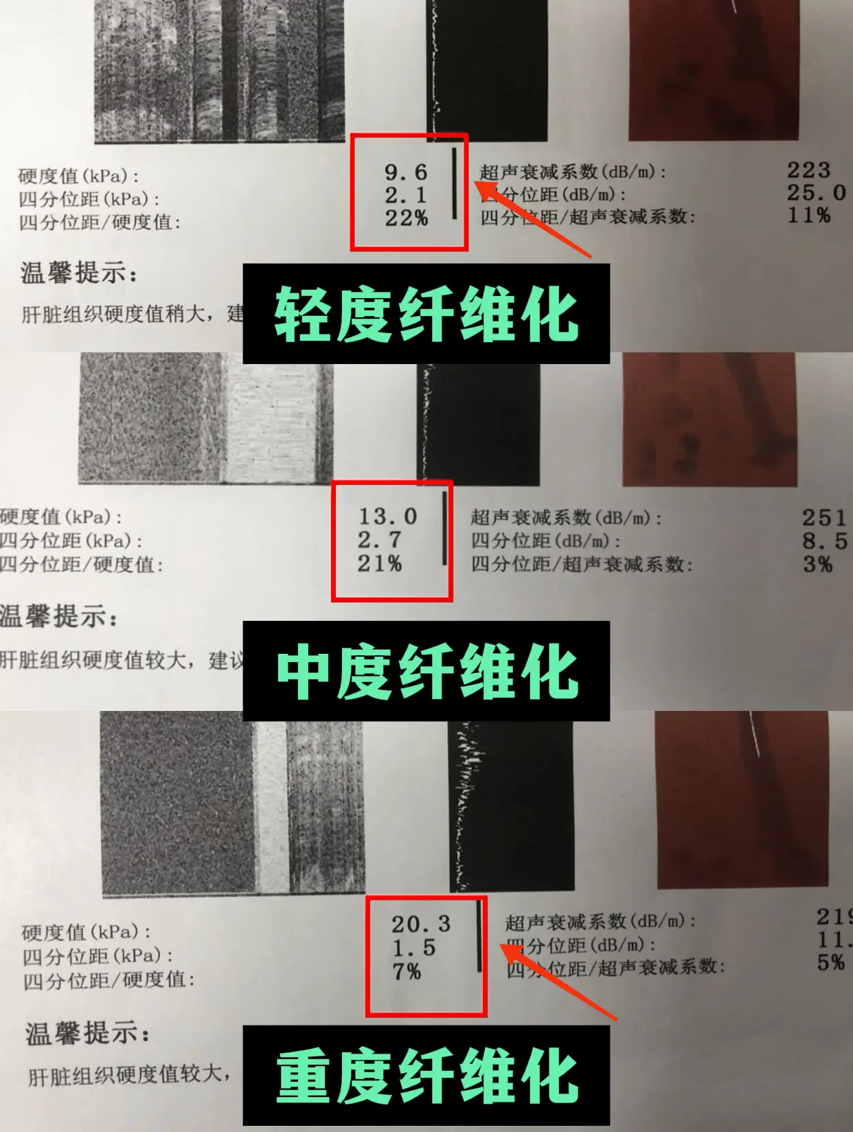 肝纤维化是肝脏在慢性损伤后发生的瘢痕修复反应，持续进展可导致肝硬化甚至...