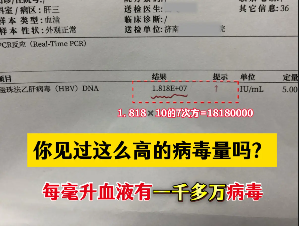 38岁的一位男士来就诊，乙肝大三阳，病毒量7次方，每毫升血液中有一千多...