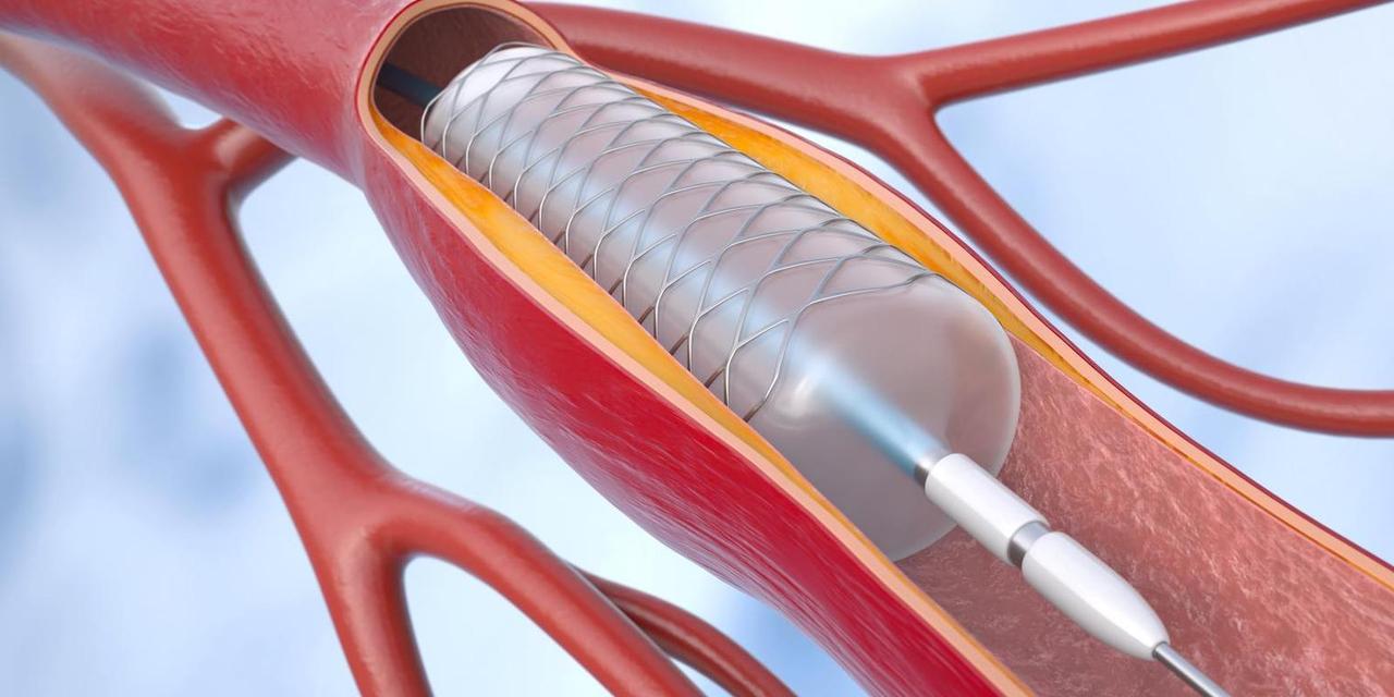 医生提醒：装上心脏支架的人，早晨1坚持，中午2避开，晚上3做到心脏支架的植入