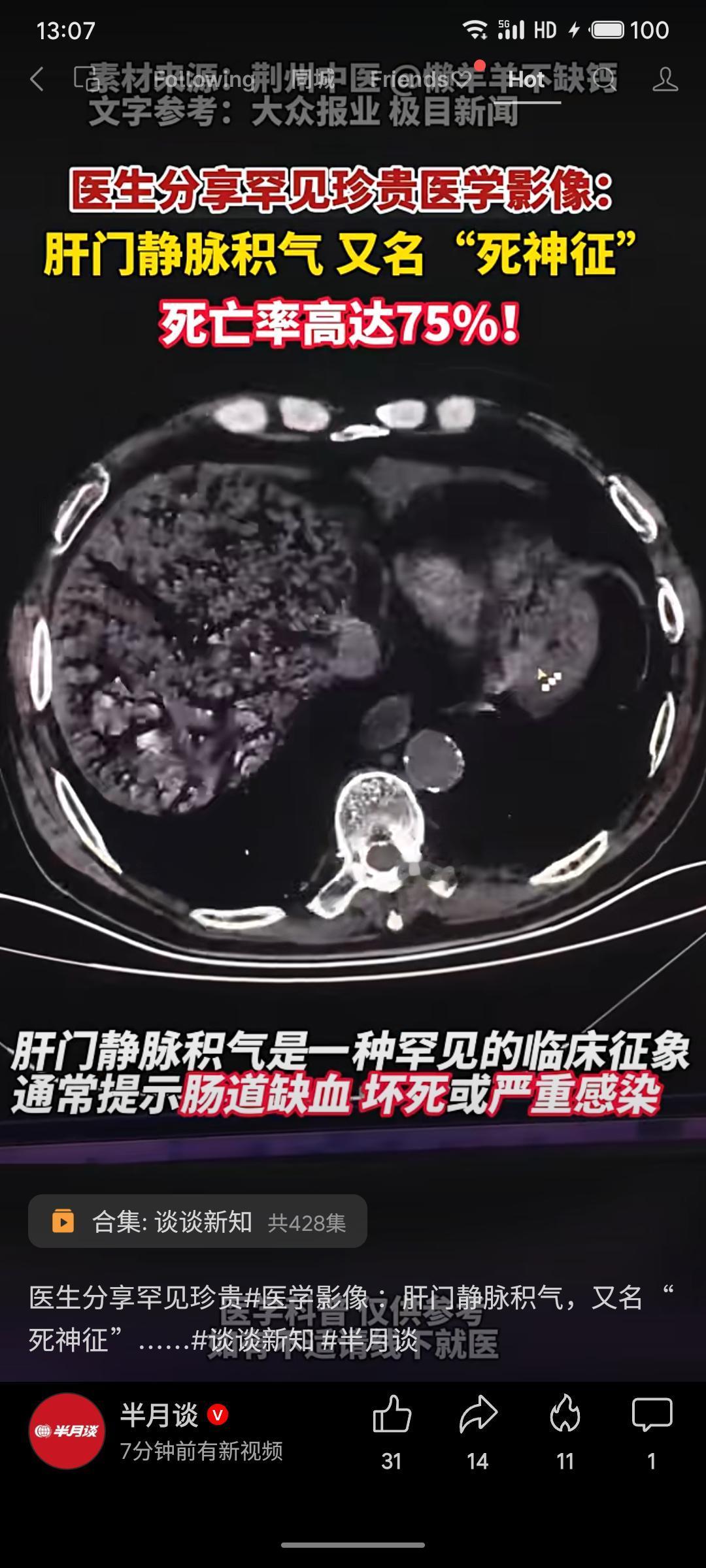 医生分享罕见医学影像“肝门静脉积气”，俗称“死神征”。该征象表现为门静脉系统内气