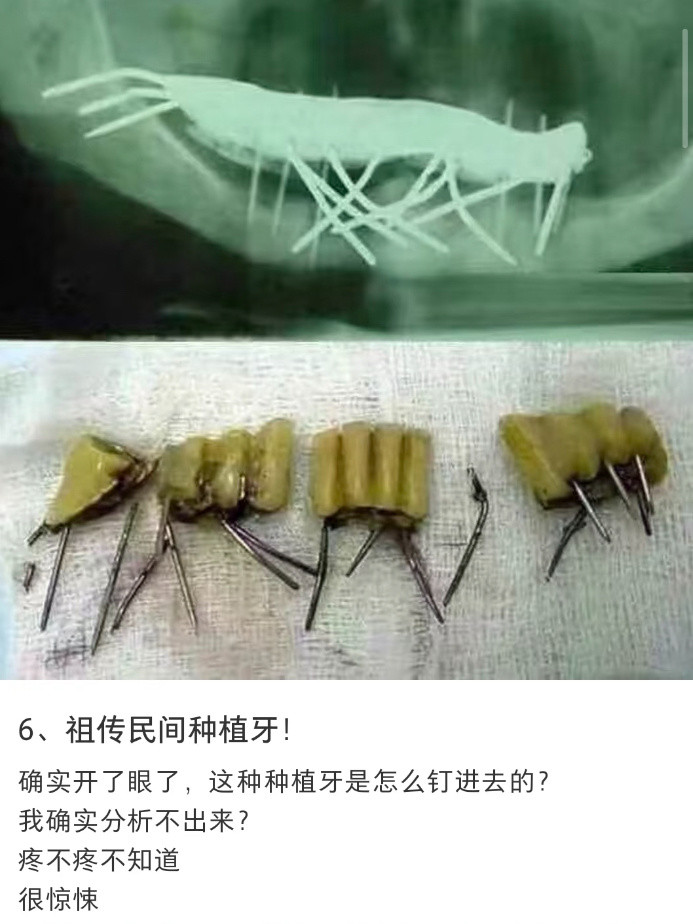 好惊悚…想起之前网购补牙材料导致凝固一嘴的老人…