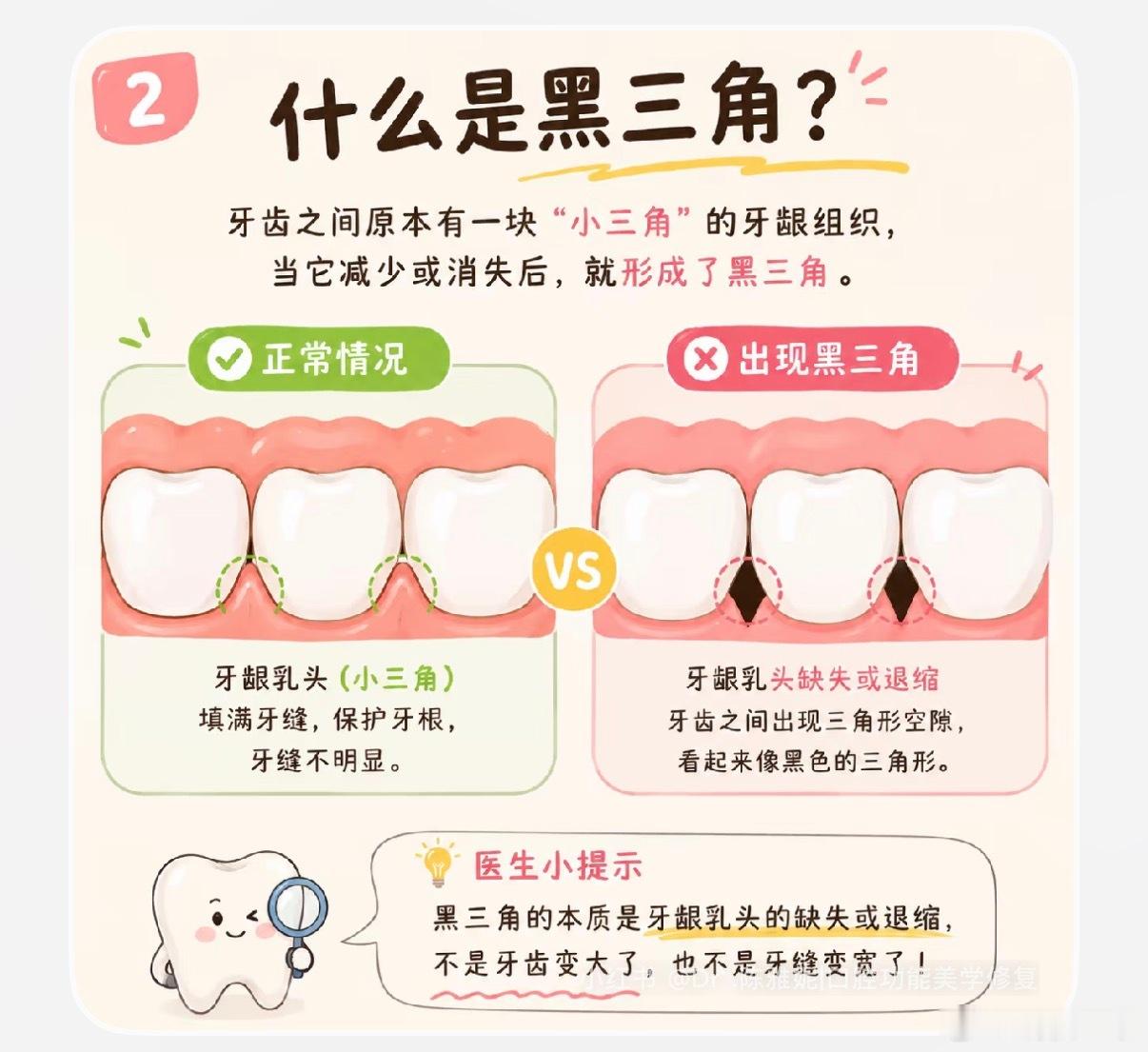 今天晚上刷牙时发现了惊喜！我因为矫正牙齿战线太长，牙龈萎缩很严重，前牙黑三角非常