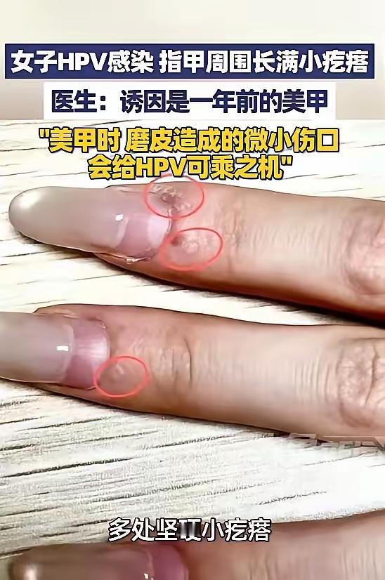 太吓人了！”5月9日报道，浙江杭州，一女子发现她的指甲周边，长了许多粗糙坚硬的
