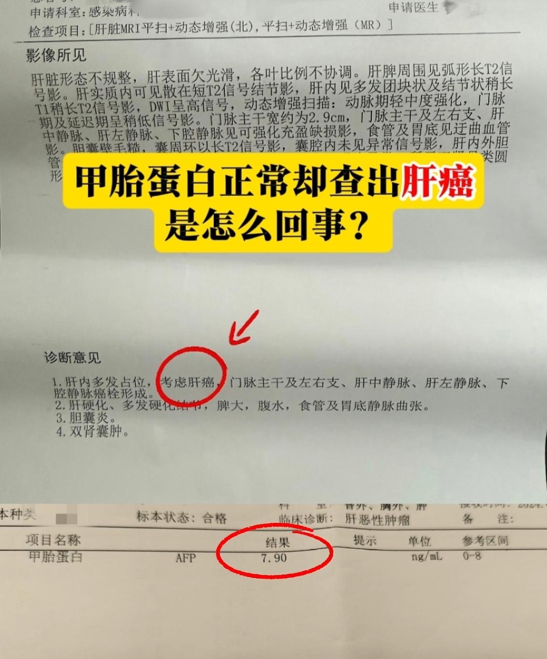 近期专家门诊上有位肝癌患者咨询，为什么甲胎蛋白数值是正常的7.9，却还...