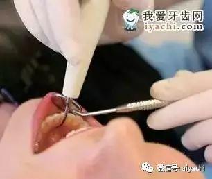 牙石清除小窍门