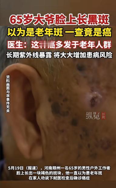 5月20日报道，河南郑州，一位65的大爷脸上长了块褐斑，他以为是年纪大了长得老年
