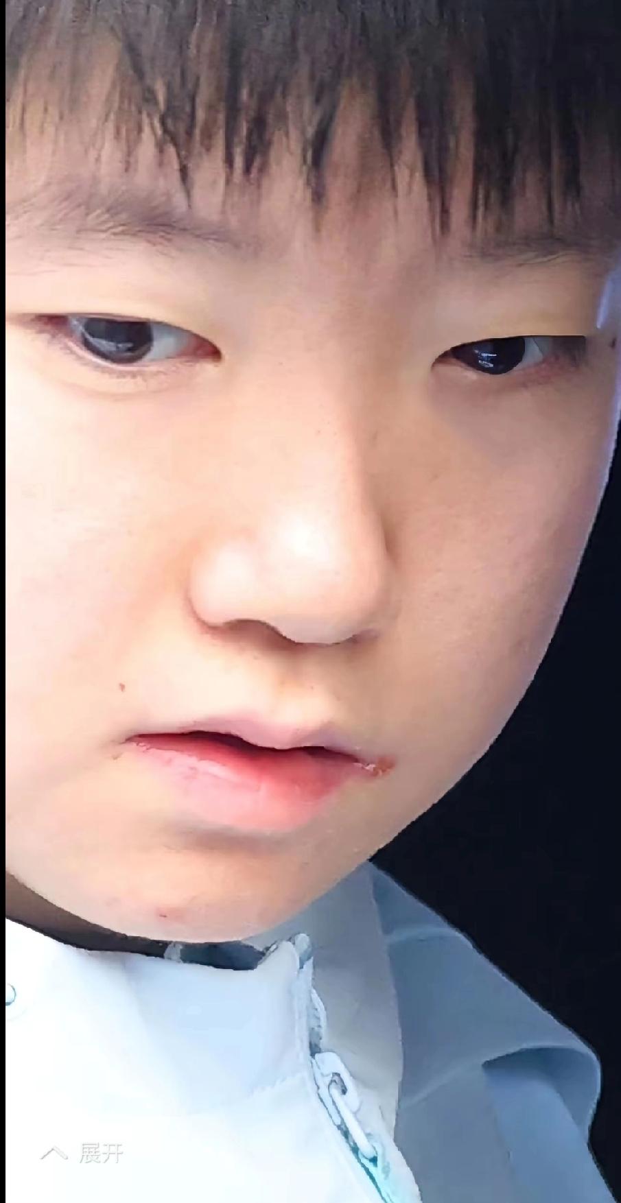 伦敦世乒赛，心疼孙颖莎的嘴角！刷到采访视频，第一眼就注意到莎莎嘴角的小伤口