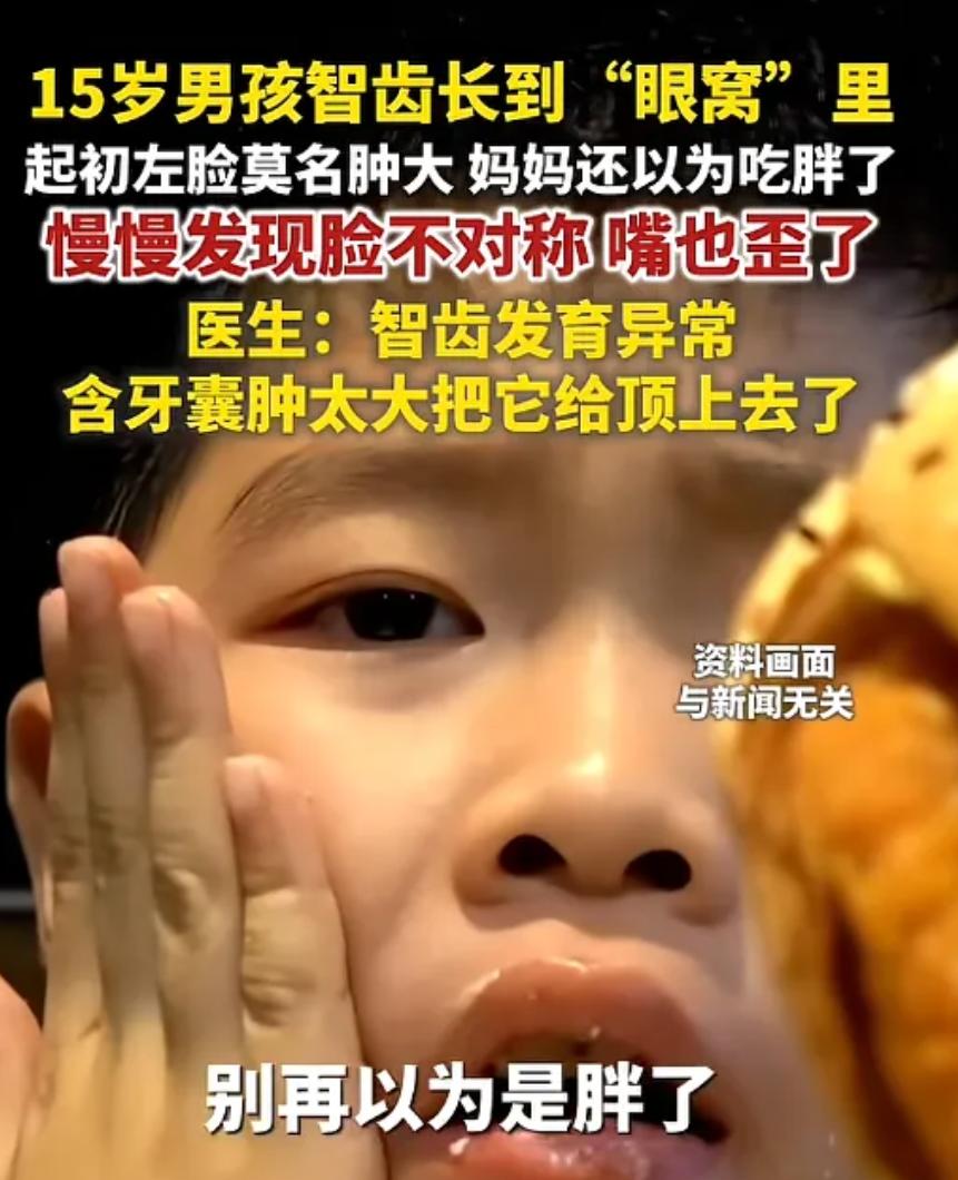 河南郑州，一15岁男孩左脸莫名肿大，妈妈刚开始还以为他吃胖了，后来慢慢发现男孩脸