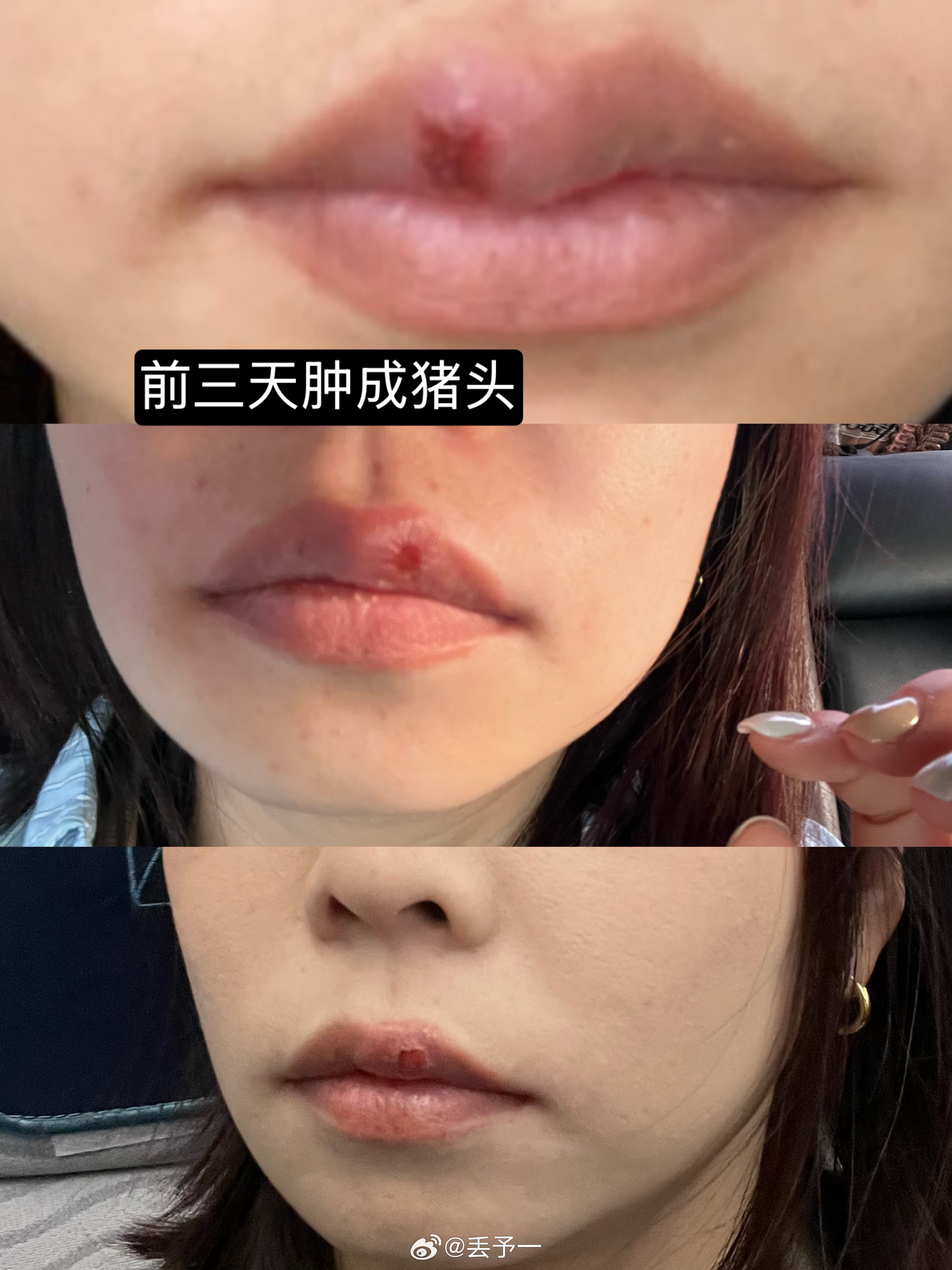 上上周带娃+打工累的突然长了疱疹，很突如其来地就觉得嘴巴疼，吃饭的时候还问朋友呢