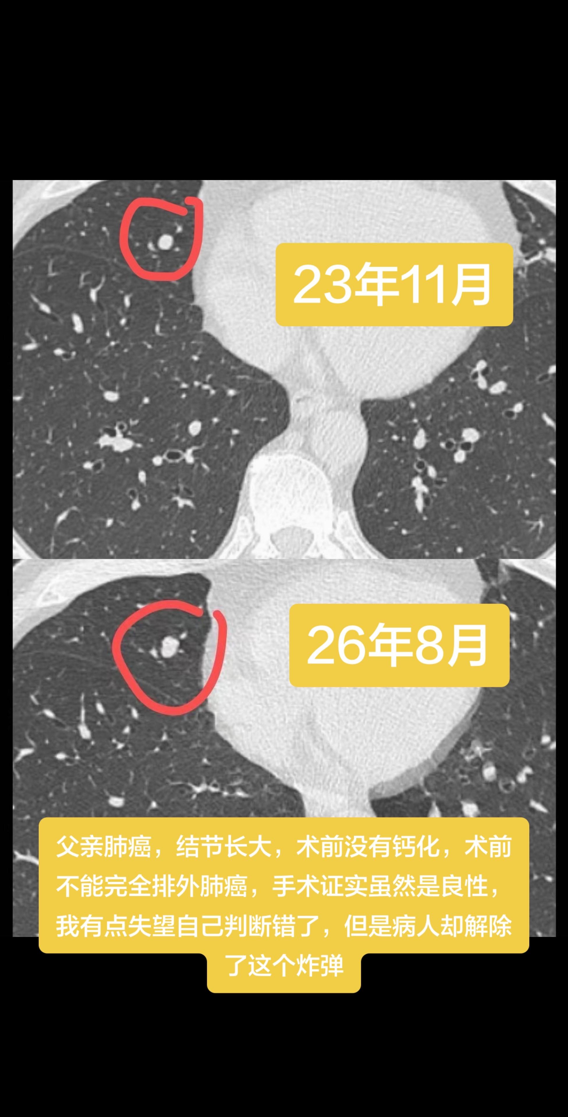 回顾自己判断错的一例病例……父亲肺癌，结节长大，术前没有钙化，术前不能...