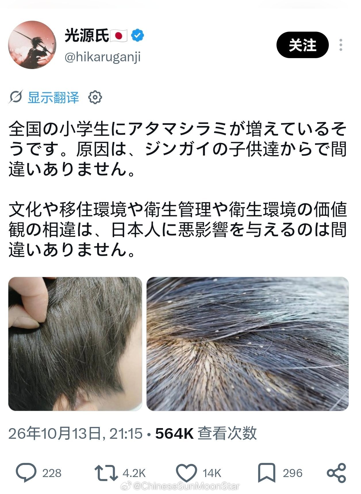 尽管日本算作发达国家，但这位日本博主用事实告诉我们，长头虱的日本儿童正在增加。尽