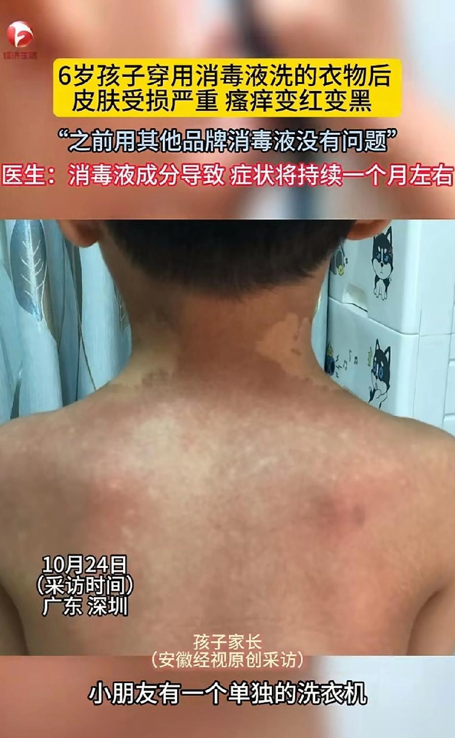 家长太讲究卫生，洗衣服放消毒水导致六岁孩子皮肤严重受损。深圳一个六岁的孩子在家