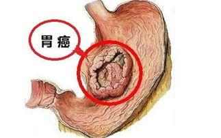 35岁女子胃癌离世, 医生警告: 这种癌会“传染”, 全家人都要小心!